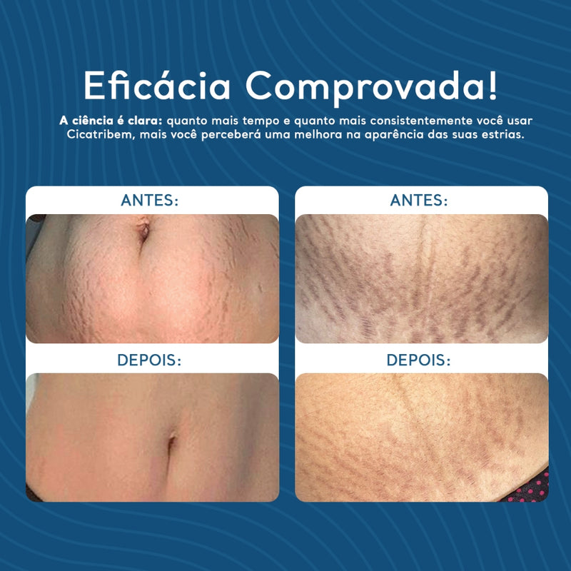 Creme Hidratante Anti Estrias Regenerador Dérmico 150g - Cicatribem - Creme para Estrias